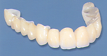 Dental Bridge